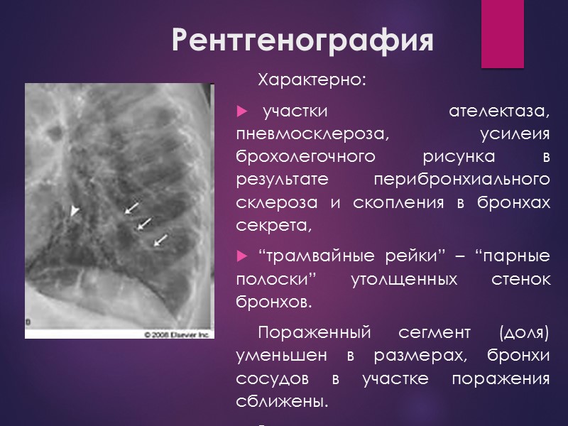 Рентгенография Характерно:  участки ателектаза, пневмосклероза, усилеия брохолегочного рисунка в результате перибронхиального склероза и